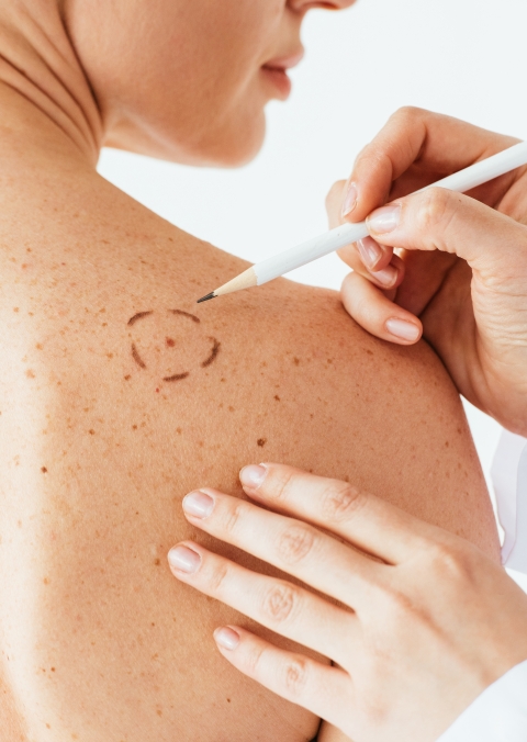 Melanoma